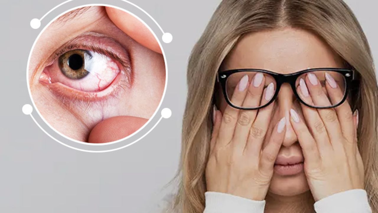 Dry Eye Syndrome